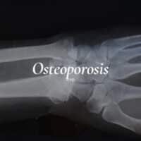 La osteoporosis se puede diagnosticar mediante densitometría ósea.