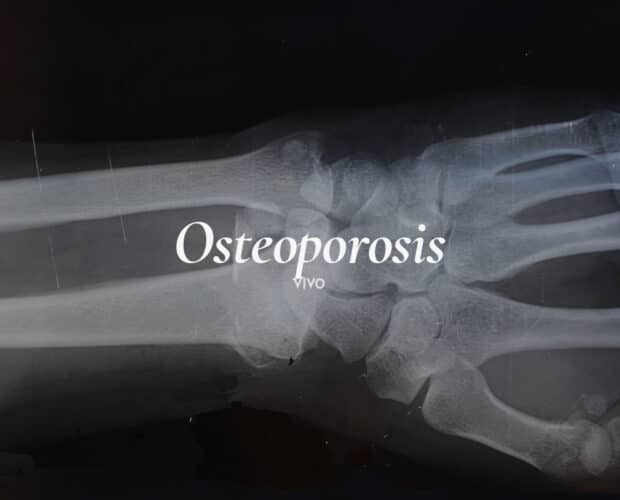 La osteoporosis se puede diagnosticar mediante densitometría ósea.