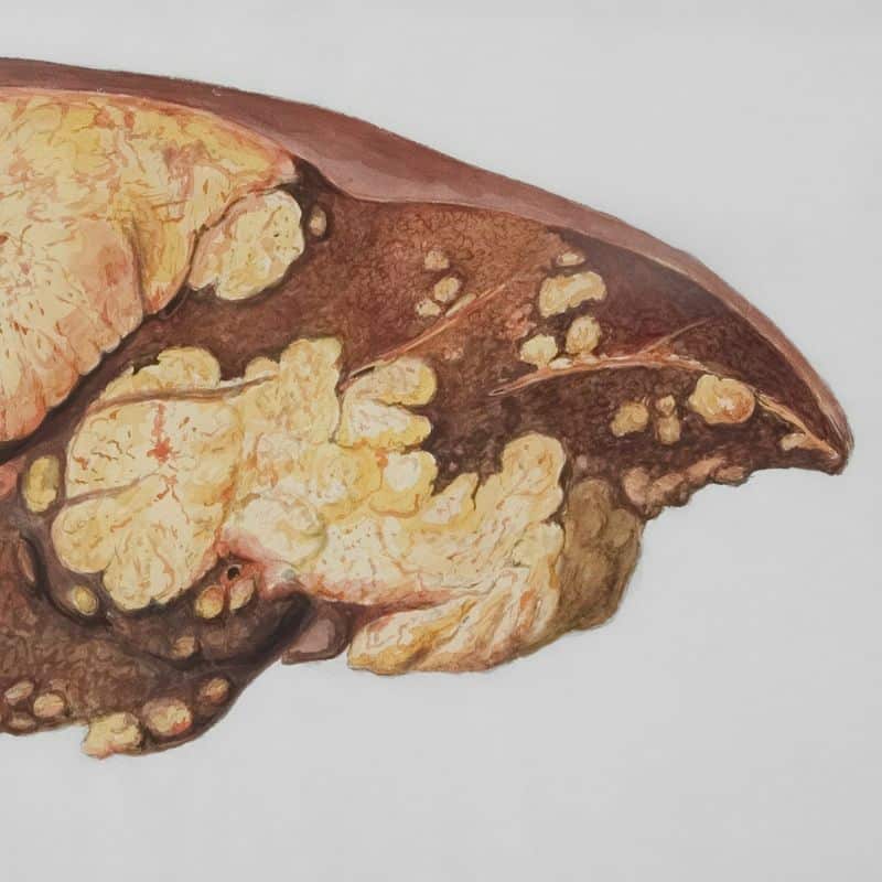 Cáncer de hígado: causas, síntomas y tratamiento.