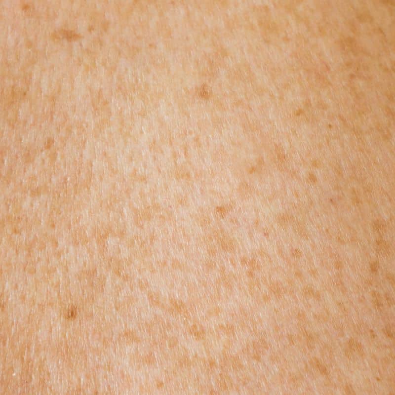 Tipos de cáncer de piel, en VIVOLABS.