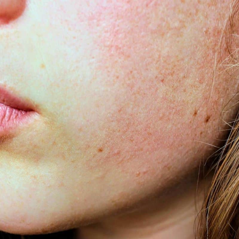 Anhidrosis: causas, síntomas y tratamiento.