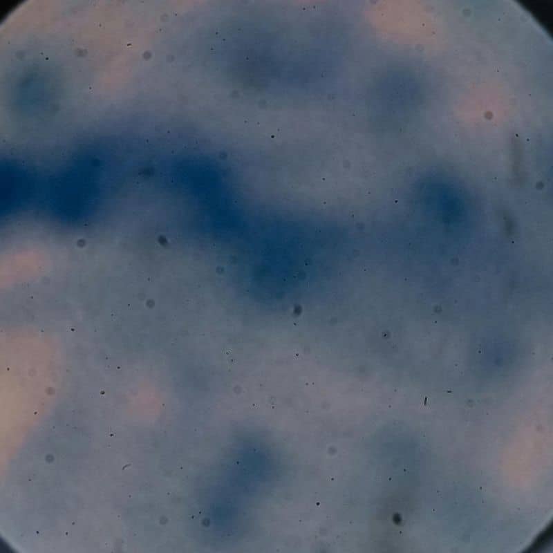 Anisakiasis: causas, síntomas y tratamiento.
