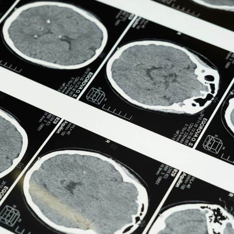 Enfermedad de Alzheirmer: causas, síntomas y tratamiento.