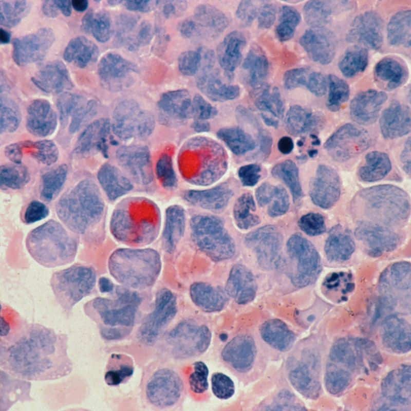 4 de febrero: día mundial contra el cáncer.