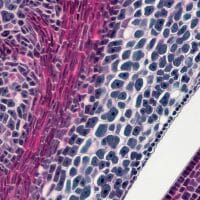 Cáncer de colon y sus estadísticas.