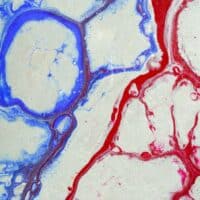 Trombofilia: causas, síntomas y tratamiento