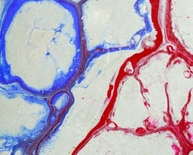Trombofilia: causas, síntomas y tratamiento