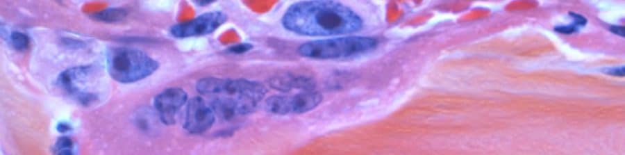 Cáncer hereditario familiar.